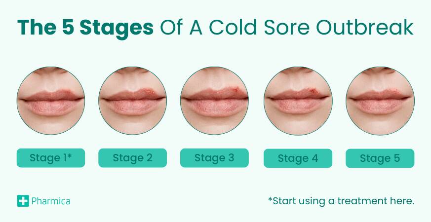 the 5 stages of a cold sore outbreak